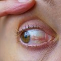 Understanding Eye Care Services: Treatments for Common Eye Conditions