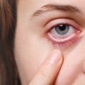 Understanding the Risks of Contact Lens Use and Eye Care Services